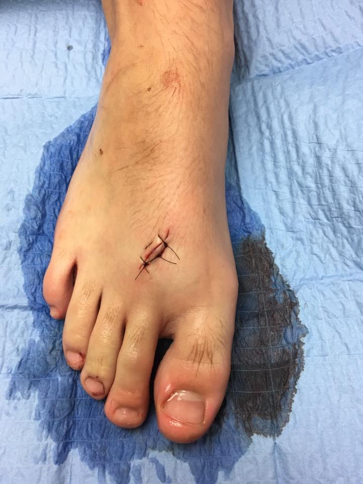 Sutured